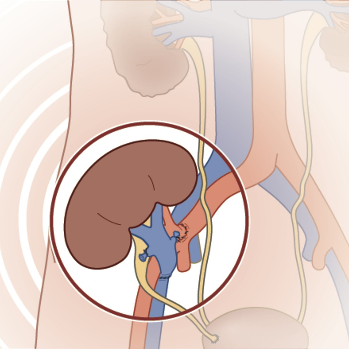 kidney transplant diagram