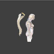 Machine Learning for Kyphosis Disease Classification
