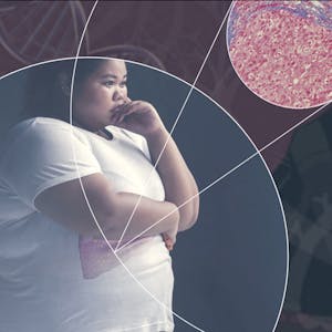 Non-Alcoholic Fatty Liver Disease – The Essentials
