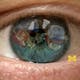 Introduction to Cataract Surgery