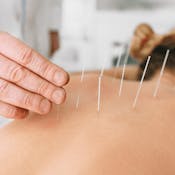 Applied Acupuncture Techniques for Common Conditions