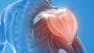 Clinical Rehab Strategies for Shoulder Dysfunction