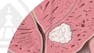 Understanding Prostate Cancer