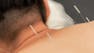 Essentials of Acupuncture: Theory & Practice